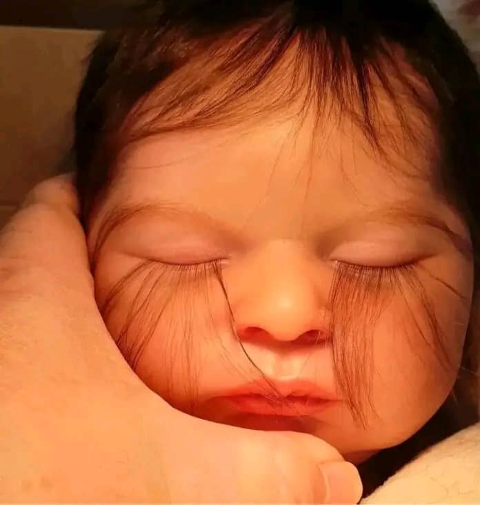 Baby Born With Lashes That Extend To Lips, Diagnosed With Eyelash Trichomegaly