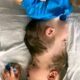 Conjoined Twins With Fused Brains Separated By Surgeons In Brazil (PHOTOS)