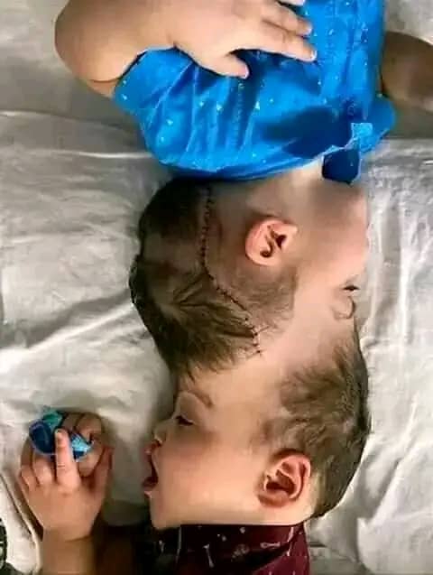 Conjoined Twins With Fused Brains Separated By Surgeons In Brazil (PHOTOS)